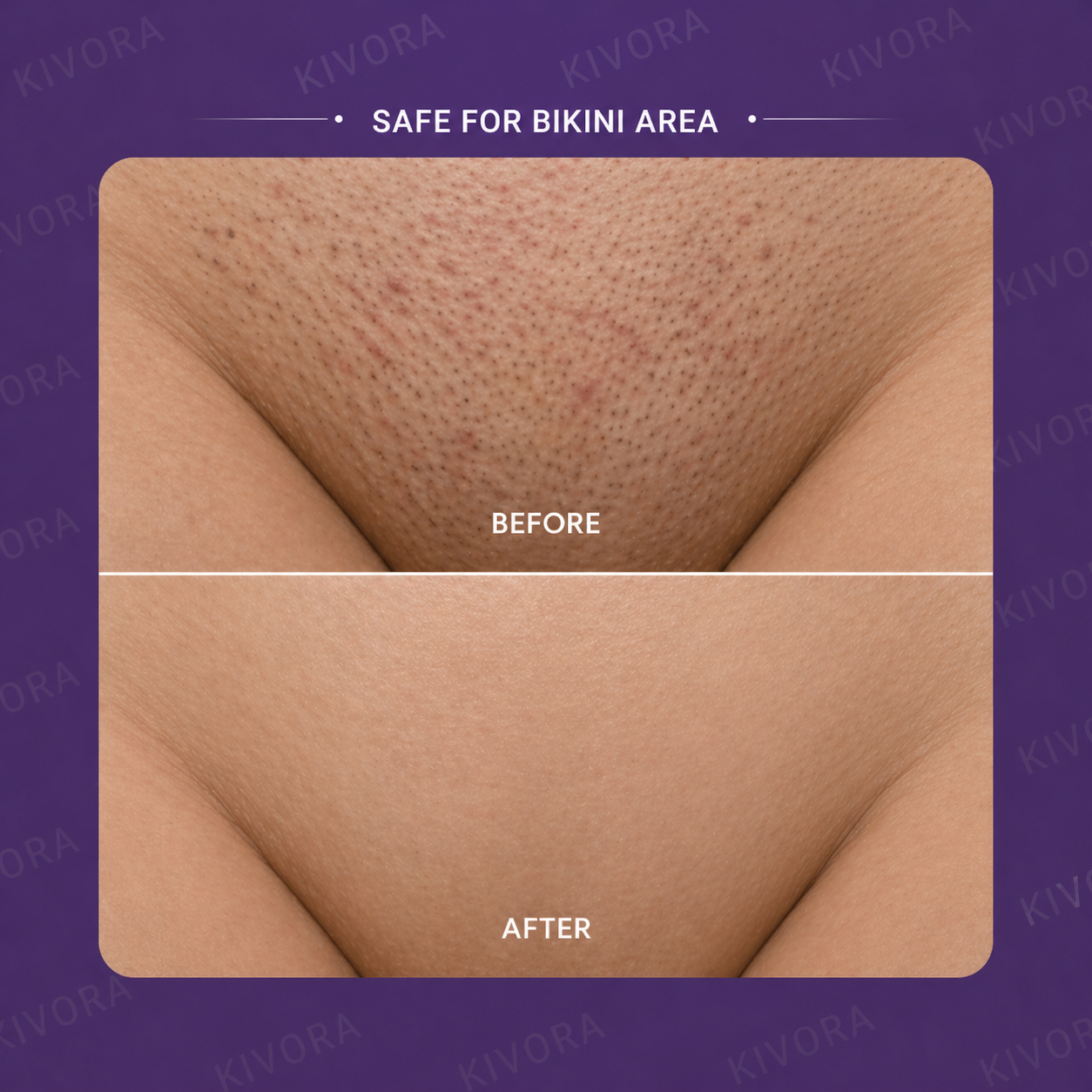 Kivora™ Hair Removal Mouse